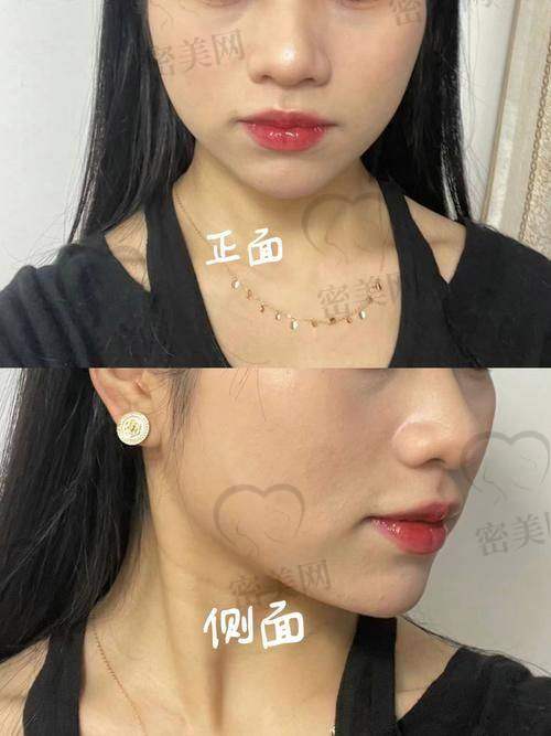 整下巴的过程