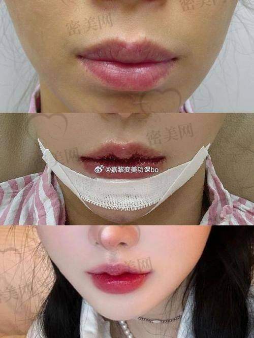 感染