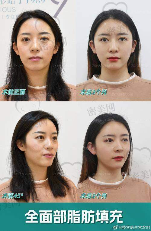 面部填充与医美机构活动
