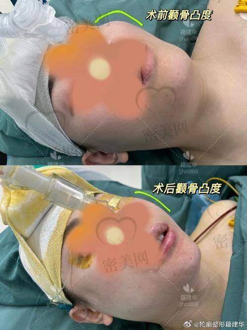 假体垫下巴过程