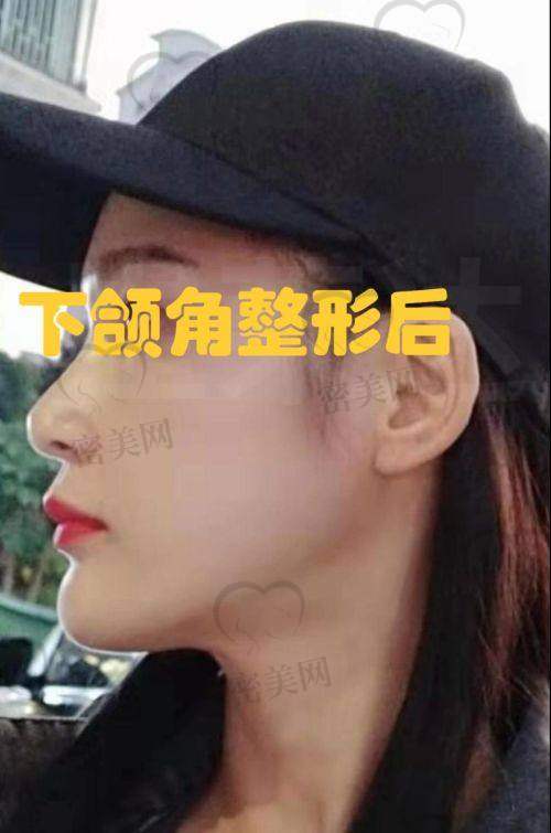 整下巴后的护理