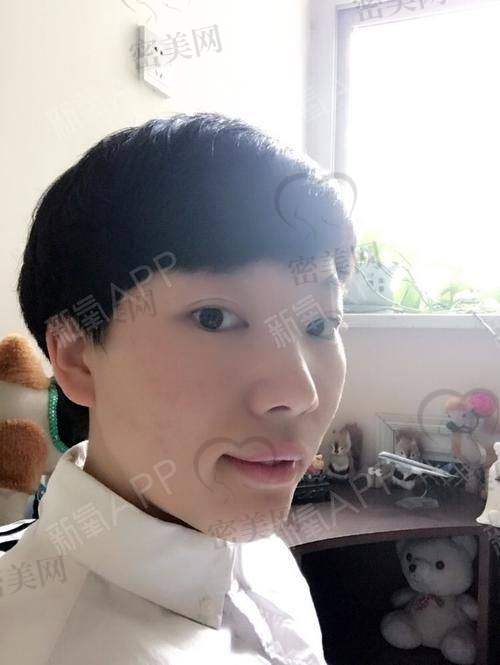 不同年龄段适合的下巴整形方式
