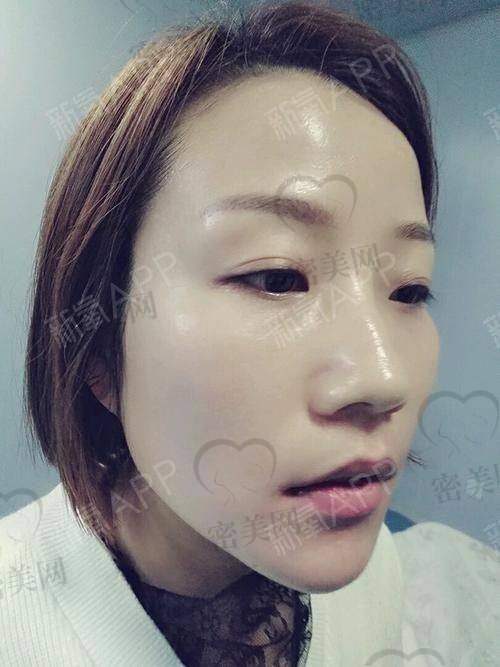 整下巴可能存在的危害