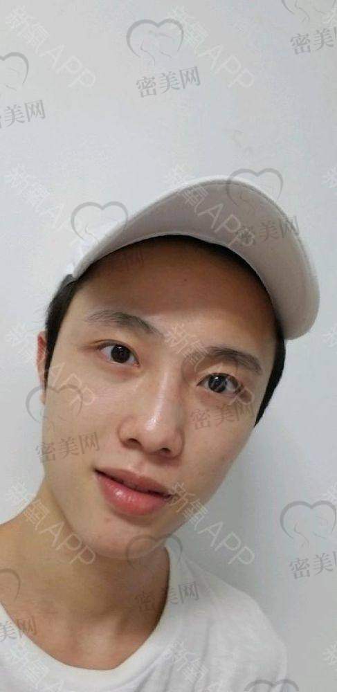 假体移位或排异