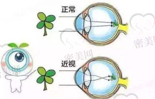 热门近视手术项目价格公开