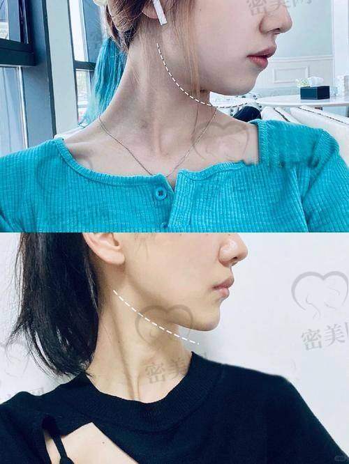 真人实例：重庆松山医院朱乐林下颌角磨骨，术后宛如换脸！