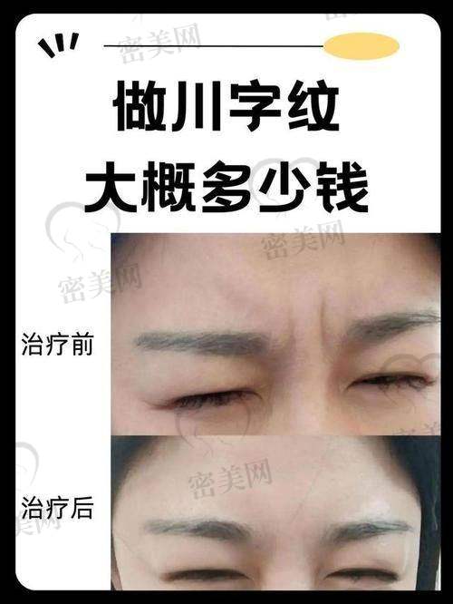 任冲医生技术特色：牛掰格拉斯