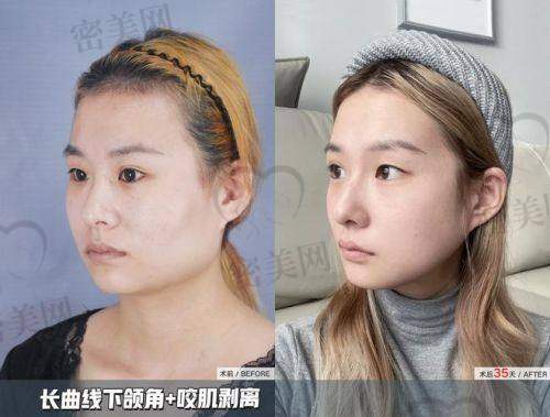 重庆松山医院：下颌角磨骨的优质之选！
