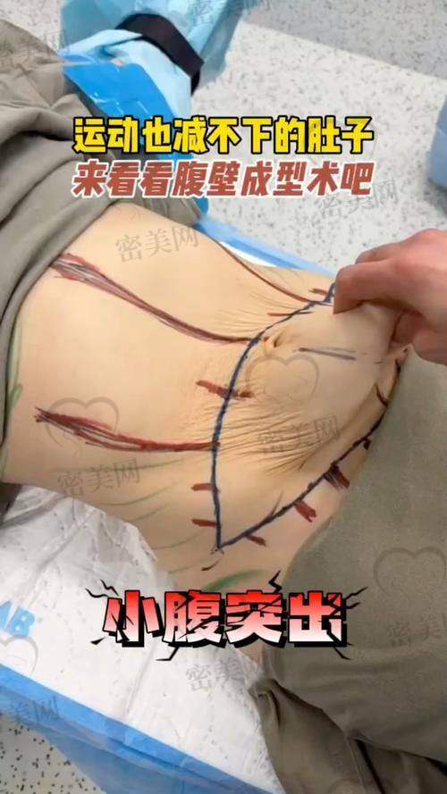 广州腹部拉皮趋向年轻化，搭配项目丰富