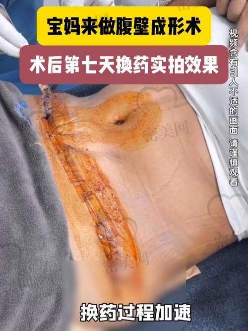北京地区腹部拉皮手术价格区间及医生风格差异