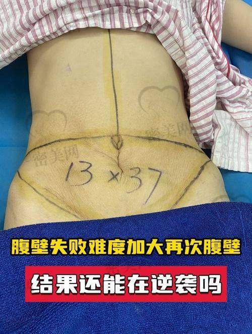 成都等二线城市腹部拉皮手术的性价比亮点