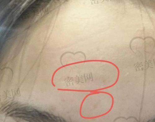 昆明美莱医疗美容：时尚派祛疤推荐地