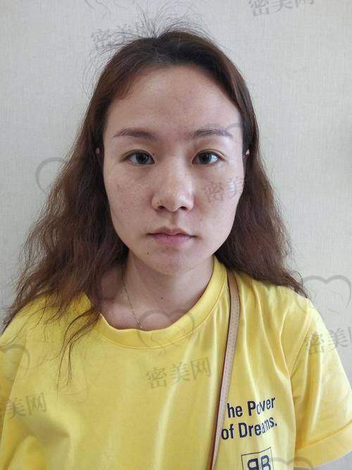 胶原蛋白填充