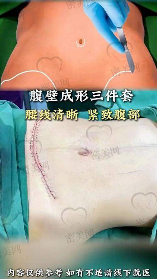 西安地区腹部拉皮价格略亲民，技术也逐步成熟