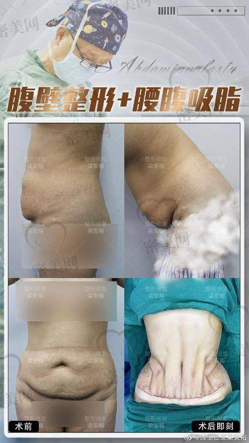 上海医生做腹部拉皮的价格门槛和服务细节