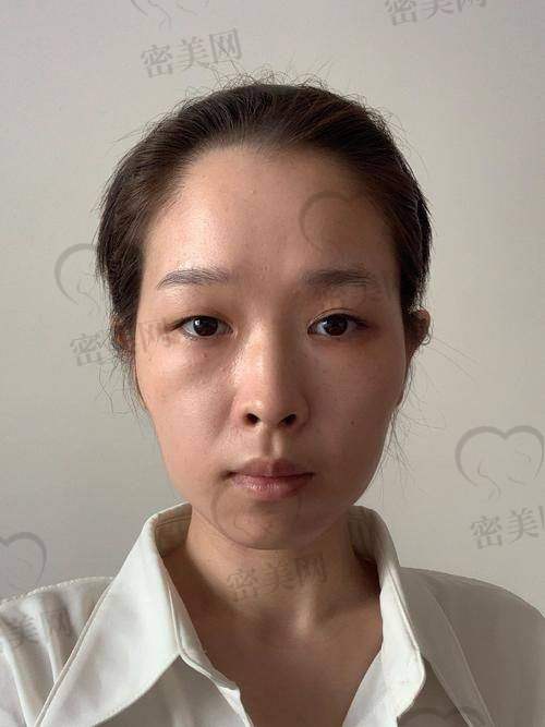 脸部填充的相关实例分享