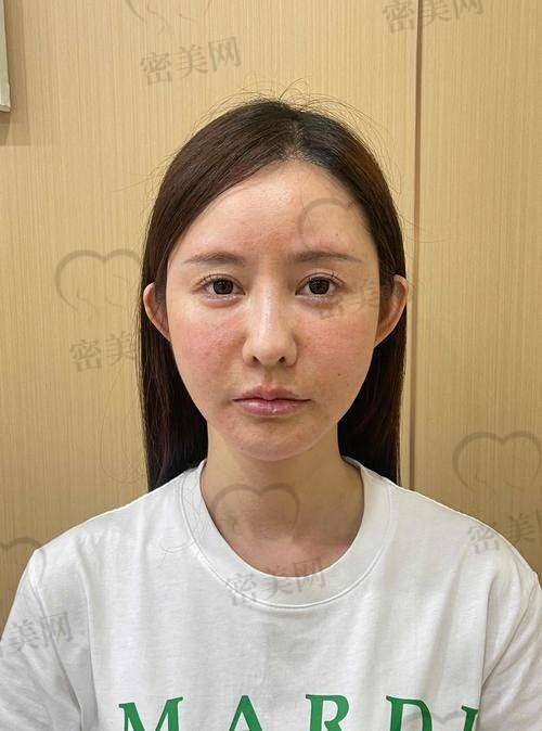 脸部填充后的注意事项