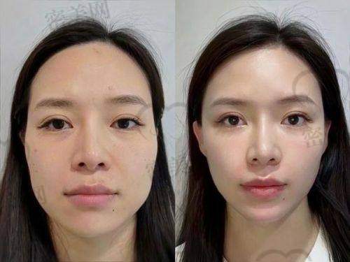 提升术后状态维持的秘密：胶原蛋白和固定强度