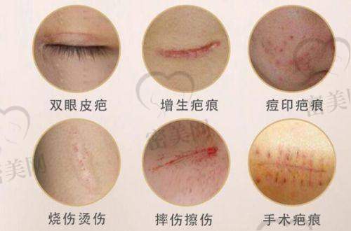 手术费之外，你可能还会花的钱
