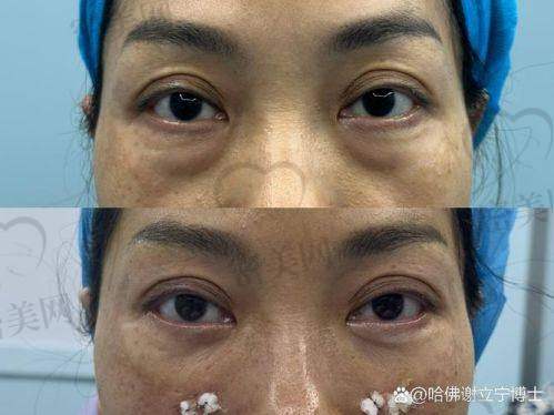 重庆华美紫馨整形医院刘天云内切眼袋眶隔释放：优势特色大揭秘！