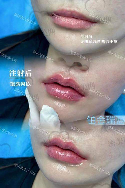 润致玻尿酸不同型号的价格揭秘