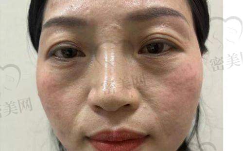 去除法令纹的非医美方法