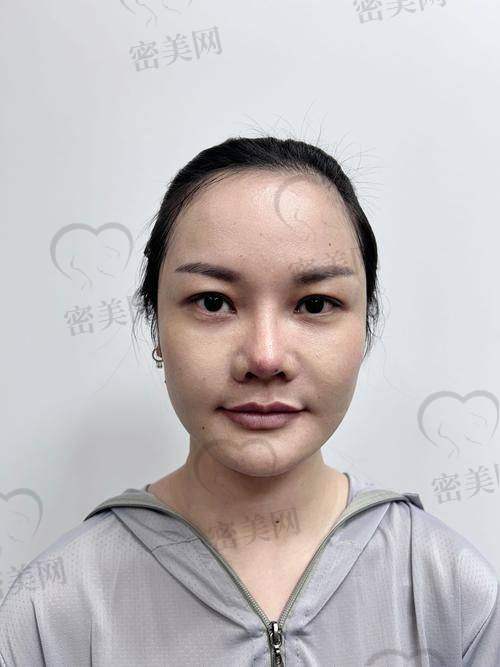 法令纹填充的价格参考