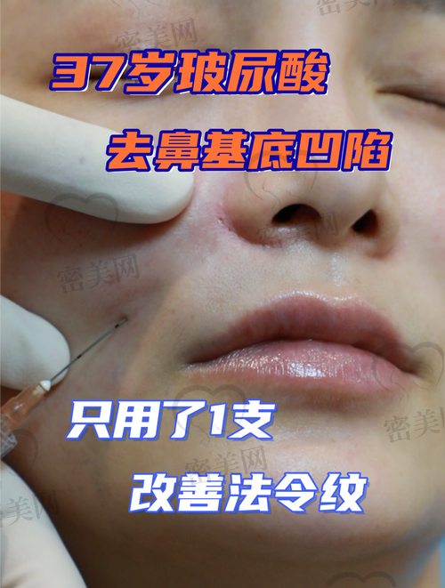 法令纹填充的利弊分析