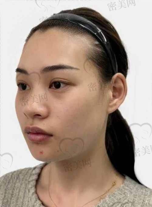 法令纹填充与切眉提眉的对比