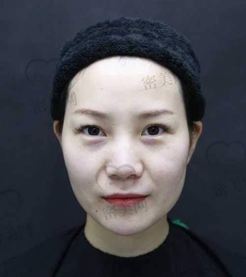 影响法令纹填充保持时间的因素