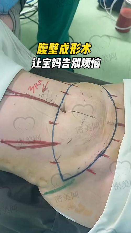 重庆松山医院徐铎医生：腹壁成型界的“超级英雄”