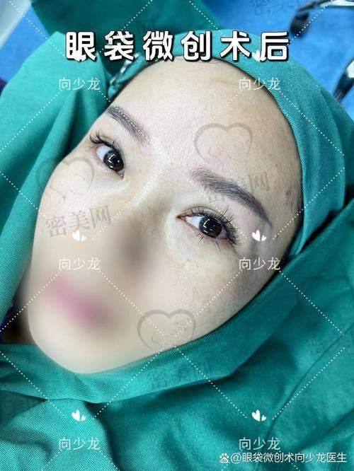 重庆华美紫馨整形医院刘天云内切眼袋眶隔释放：口碑评价超棒！