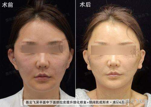 术后修复：惊喜连连的蜕变
