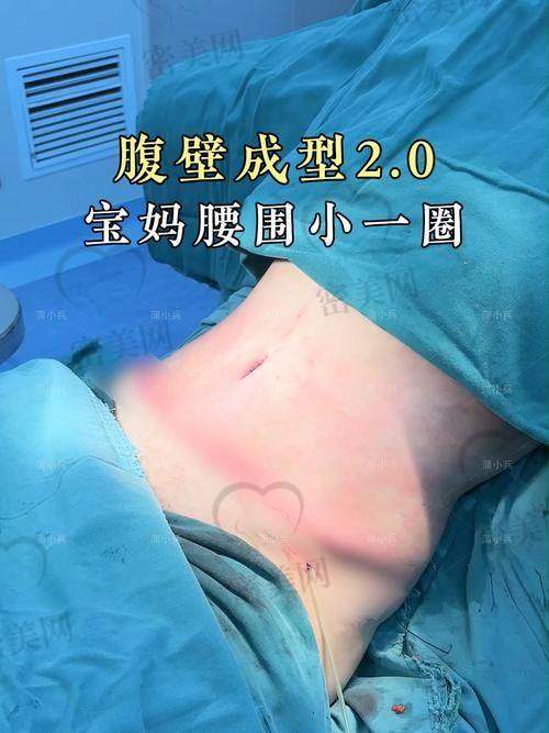 重庆松山医院徐铎腹壁成型术65000起，重塑平坦腹部，尽显自信魅力！