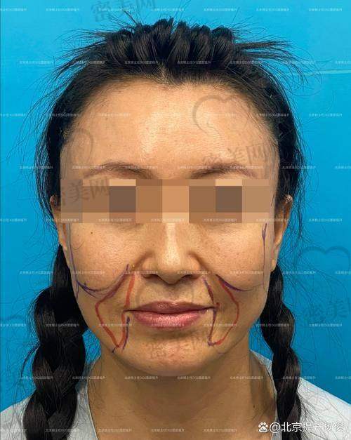 王阔远：精细化“协和系手术风格”，适配复杂馒化脸修复