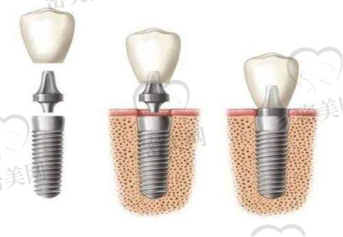 【秦皇岛伍颗芽口腔诊所参考价格表:】