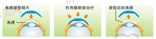 昆明眼科圆锥角膜交联术费用详解：是否能报销？