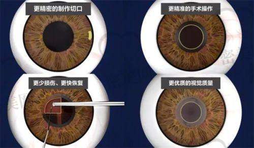 手术到底值多少钱？这张表告诉你不花钱省了多少！