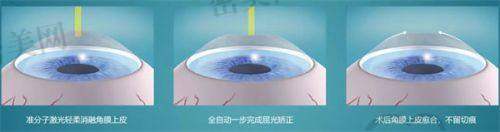 在乌鲁木齐普瑞眼科做白内障手术续航体验如何?