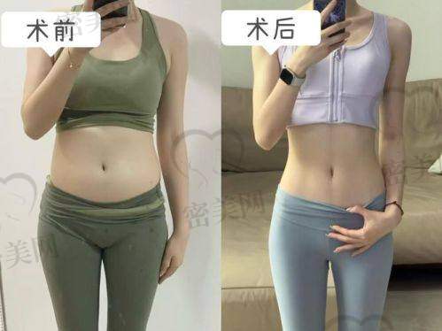 重庆华美紫馨整形医院刘天云：6800 元开启腰腹塑形狂欢