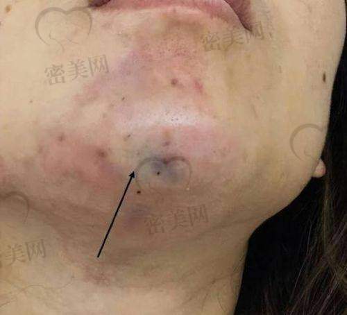 不同年龄段女性适合的整形项目与45岁面部填充的意义