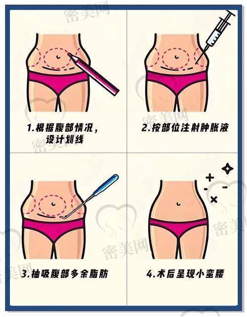 重庆华美紫馨整形医院刘天云腰腹环吸：真人实例见证奇迹