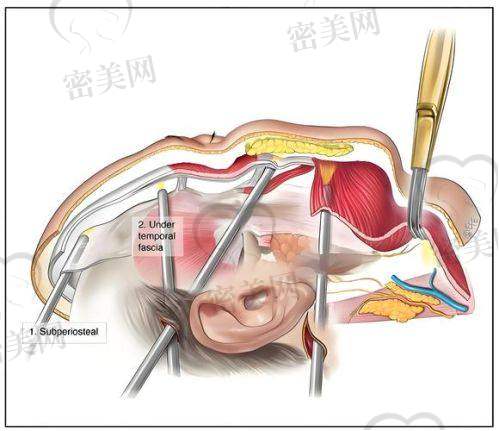 重庆华美紫馨整形医院刘天云眉眼小拉皮：神奇优势大揭秘