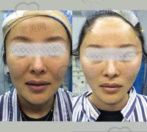 重庆华美紫馨整形医院刘天云眉眼小拉皮：真人实例大震撼