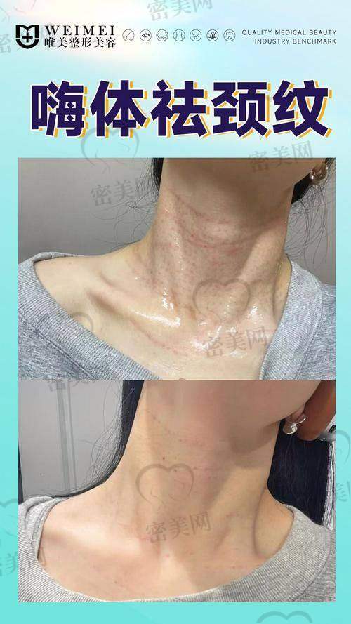 嗨体 1.5 和 2.5 打细纹谁更好