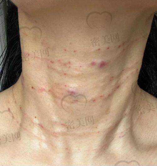 祛颈纹嗨体一针多少钱