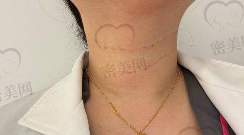 嗨体一次打几针能维持多久