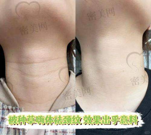 润致玻尿酸 2 号、3 号与 5 号区别