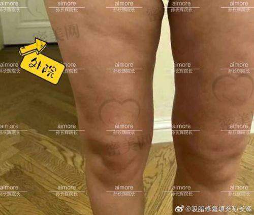 任义医生：局部雕刻一绝，适合直角腰/马甲线打造