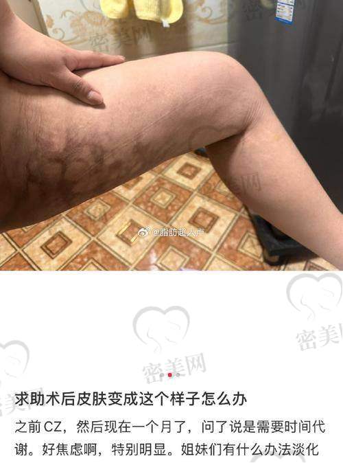 赵善军 医生：吸脂稳将，追求对称与安心的代表